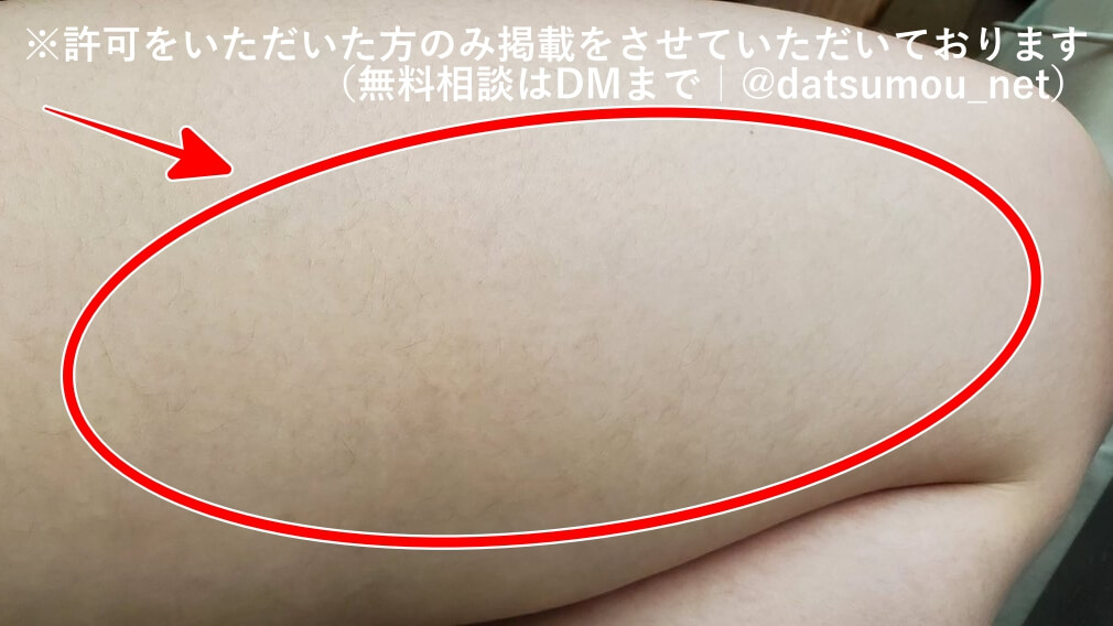 右太もも(外側)